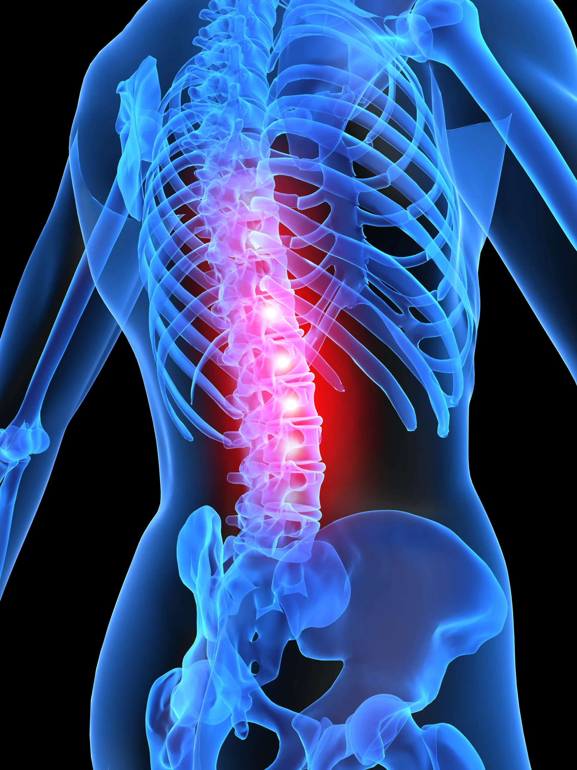 Herniated Discs After a Car Accident