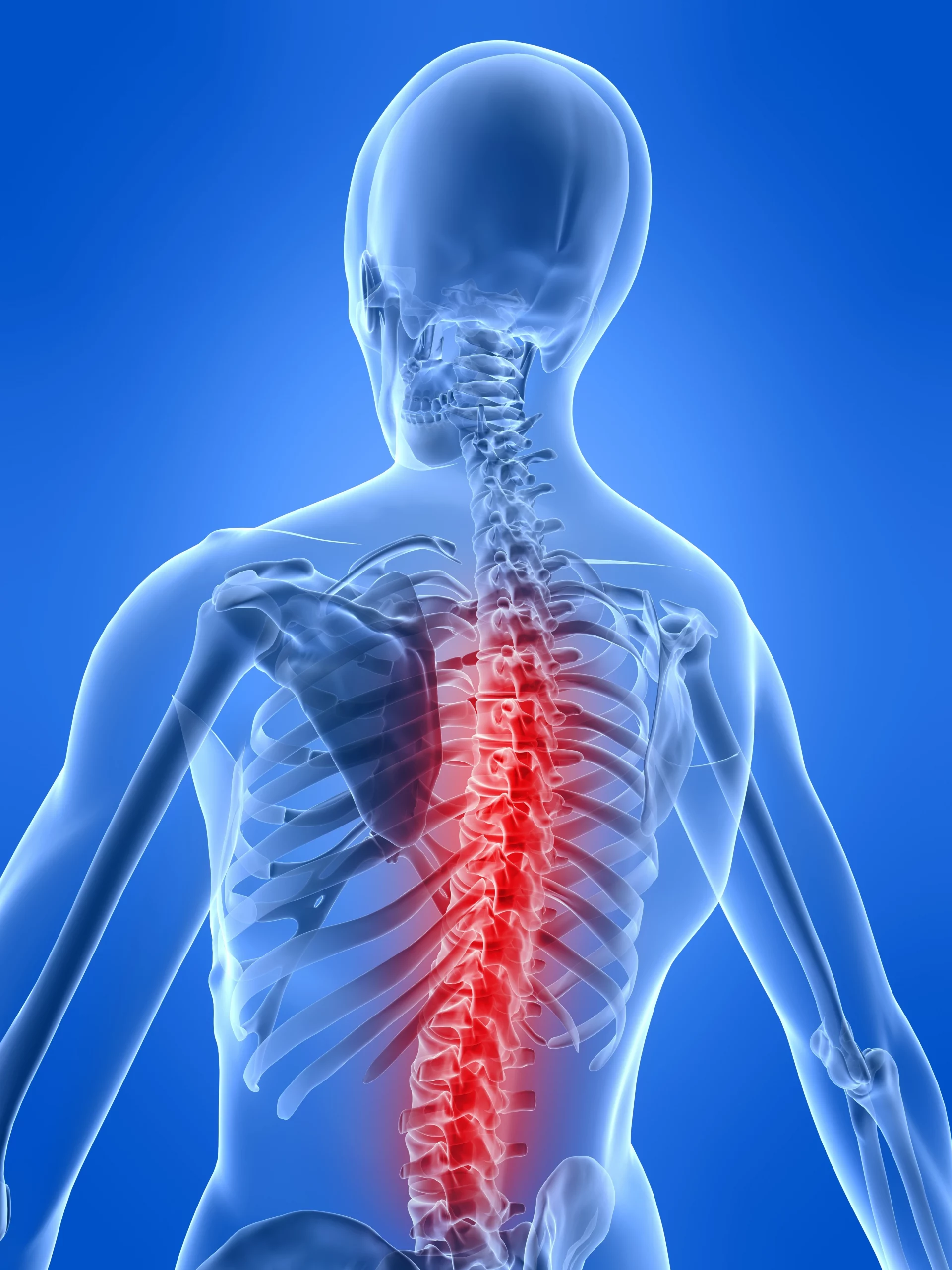 Spinal Fracture Accidents